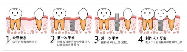 种植牙需要多长时间